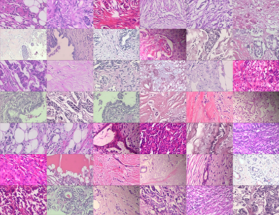 Semi-supervised learning for R&D of AI-powered cancer pathology