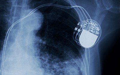 Inside the new generation of medical implants
