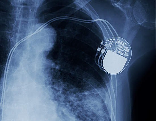 Inside the new generation of medical implants