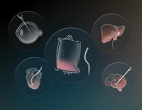 Drug delivery device innovation in cell and gene therapies